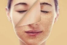 التخلص من جفاف البشرة